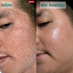 SpicuClear Micro-Needle Serum