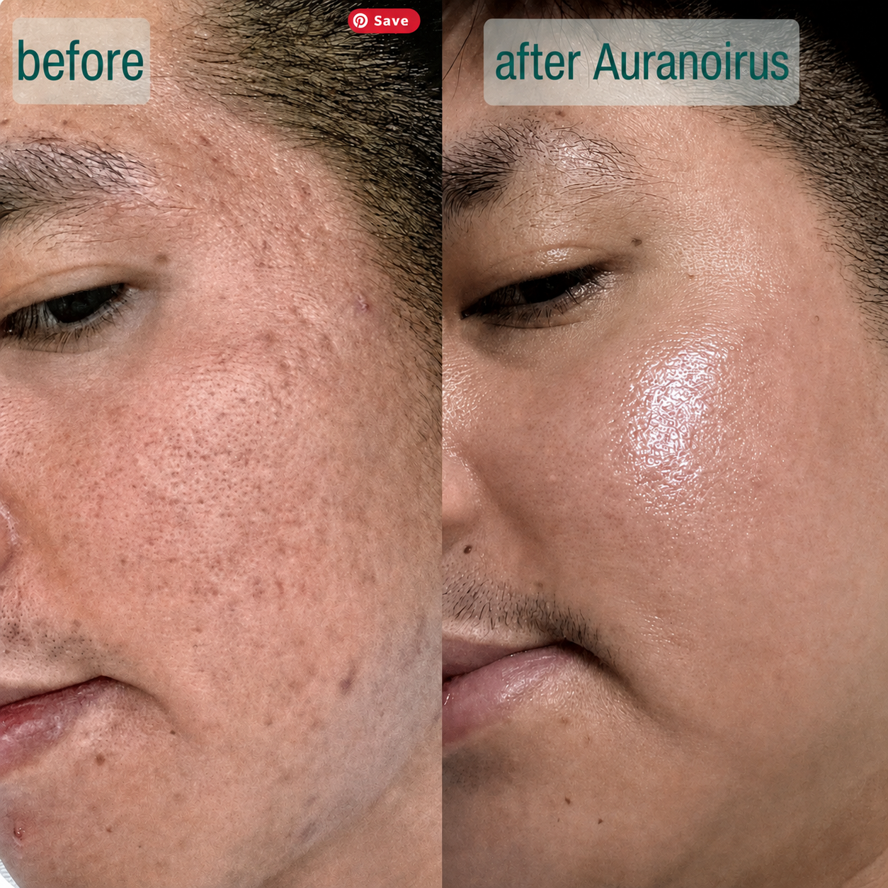 SpicuClear Micro-Needle Serum