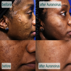 SpicuClear Micro-Needle Serum