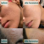 SpicuClear Micro-Needle Serum